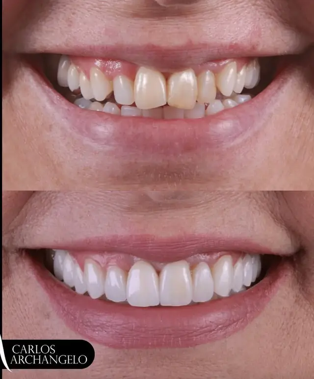 Antes e depois com laminados — trabalho do Lab Romanini