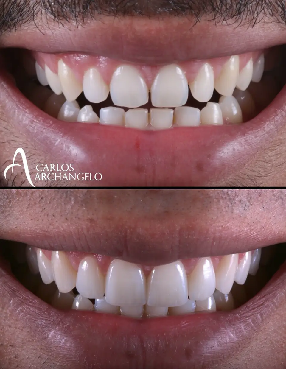 Antes e depois de prótese estética — trabalho do Lab Romanini