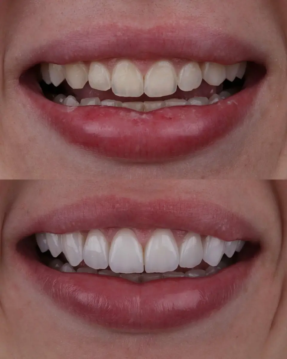 Antes e depois de sorriso — trabalho do Lab Romanini