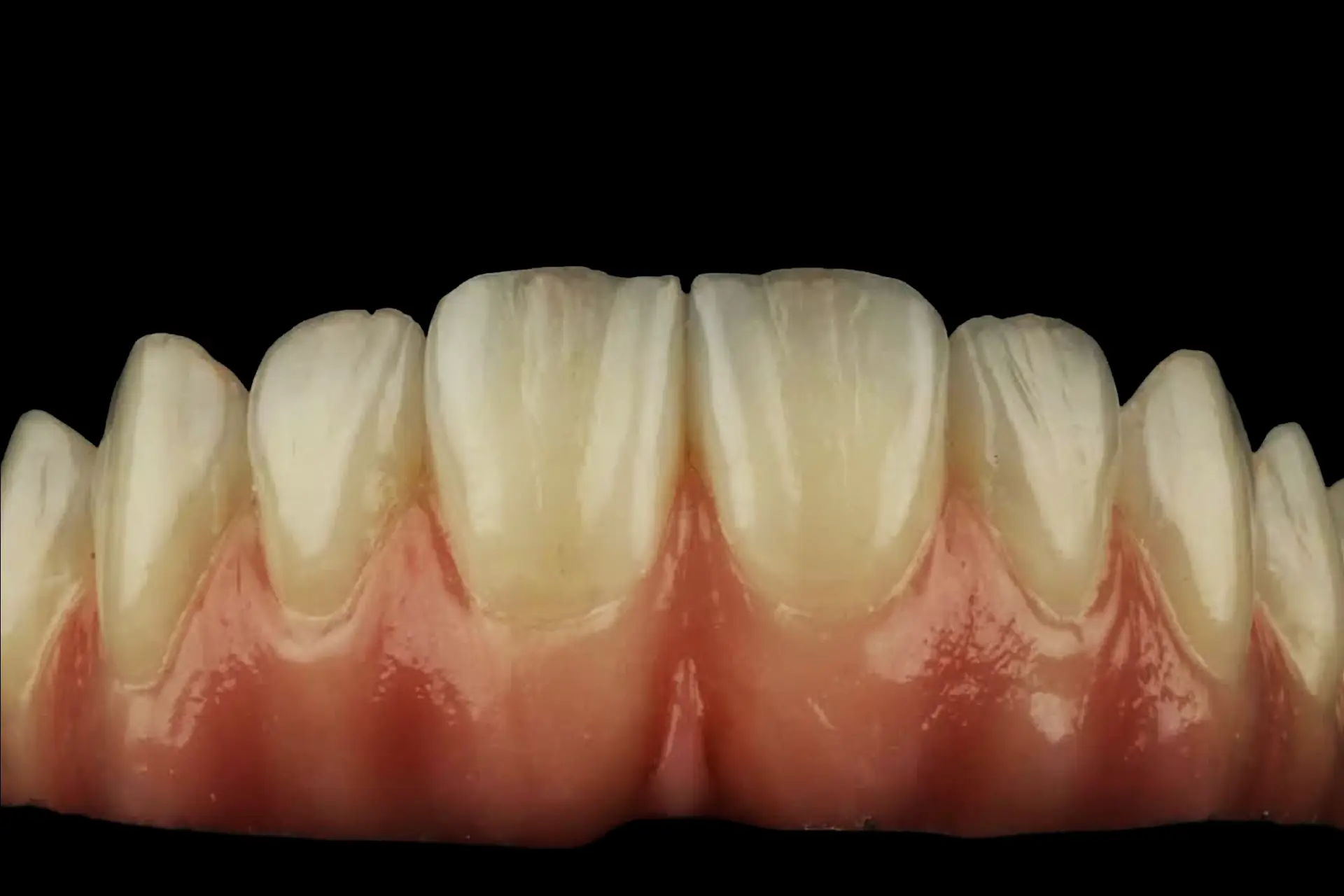 Lentes de contato dentais produzidas no Lab Romanini