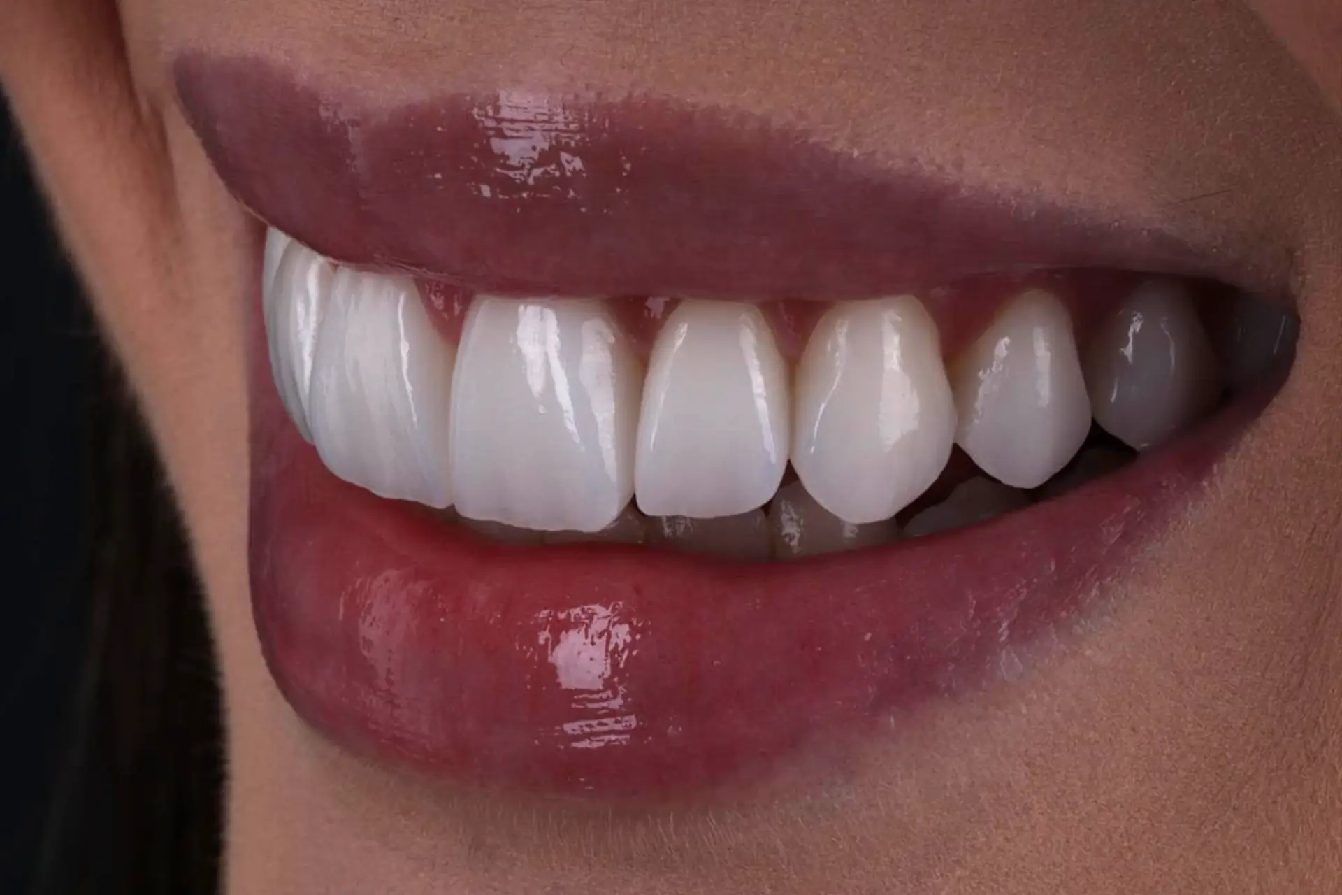 Sorriso com laminados cerâmicos produzidos no Lab Romanini