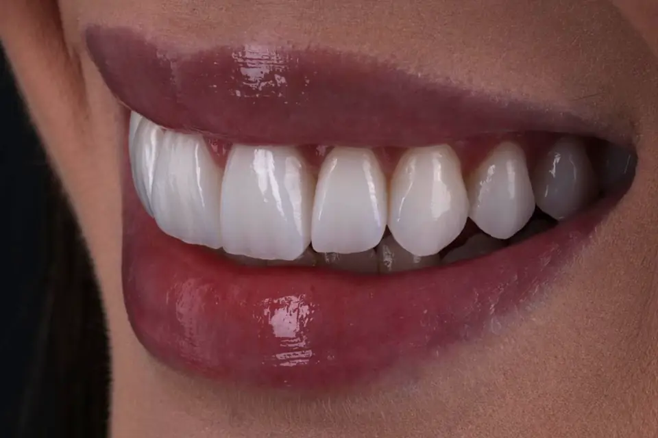 Sorriso com laminados cerâmicos produzidos no Lab Romanini