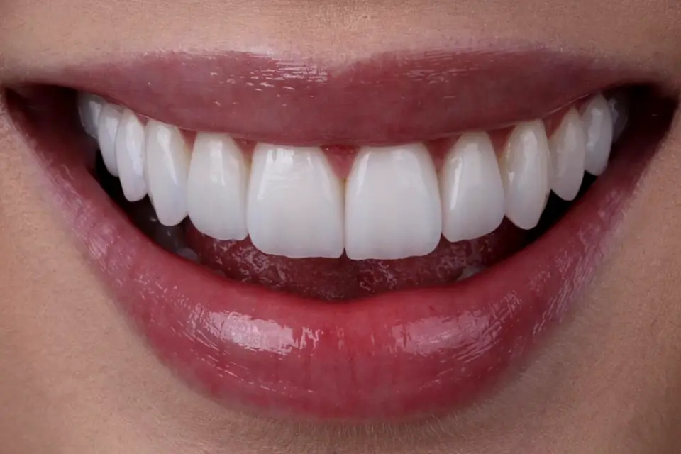Sorriso restaurado com próteses sobre implantes do Lab Romanini